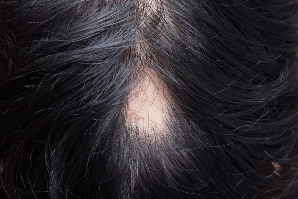 【医師監修】AGAの段階ごとの特徴と対策を徹底解説｜早期発見が未来の髪を守る鍵
