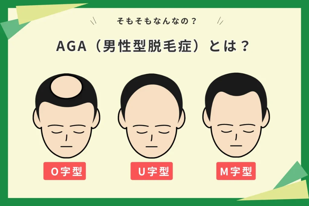 AGA治療　オンラインクリニック　種類