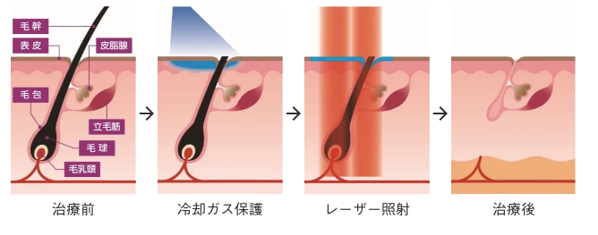 GentleMax Proによる脱毛のメカニズム