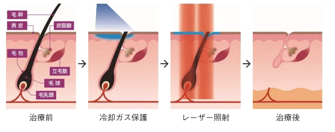 GentleMax Proによる脱毛のメカニズム